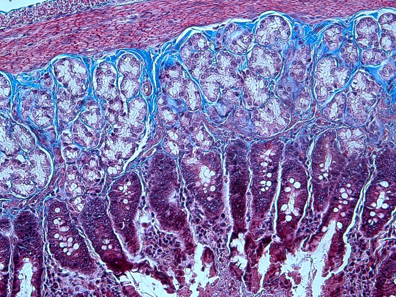The role of collagen in cancer: from bench to bedside